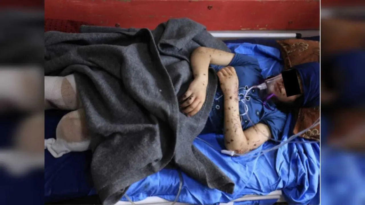 La niña, internada en el hospital Naser de la localidad de Jan Yunes, en el sur de la Franja de Gaza, se niega a imaginarse con prótesis. Foto: AFP