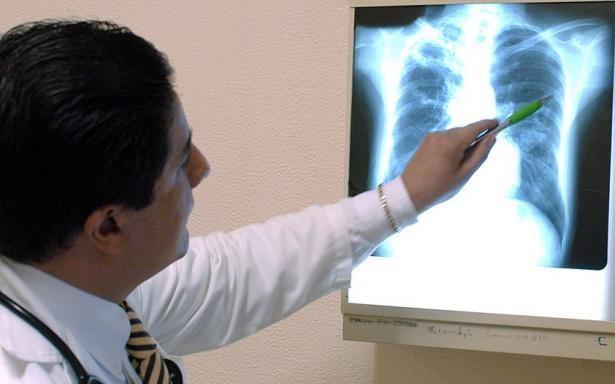 Invitan a la población estar alerta sobre la tuberculosis. Foto de IMSS Coahuila.