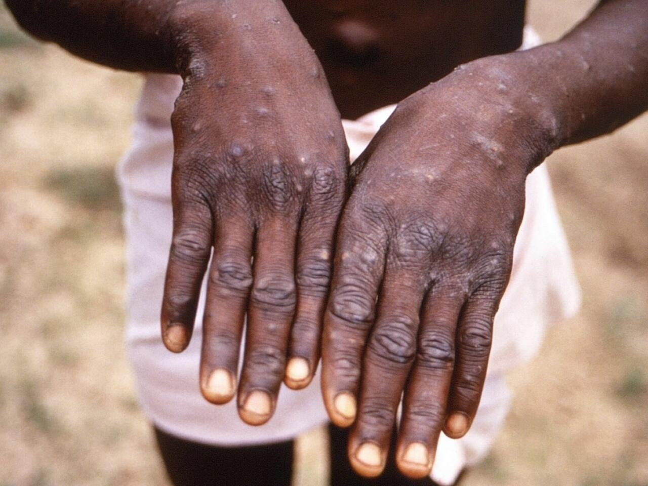 Esta variante  del virus, descendiente de la cepa mpox de clado 1. Foto: France 24.