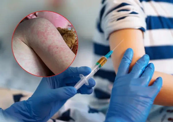 17 fallecimientos y más de 4 mil casos de sarampión en México; Chihuahua concentra el 95% de los contagios