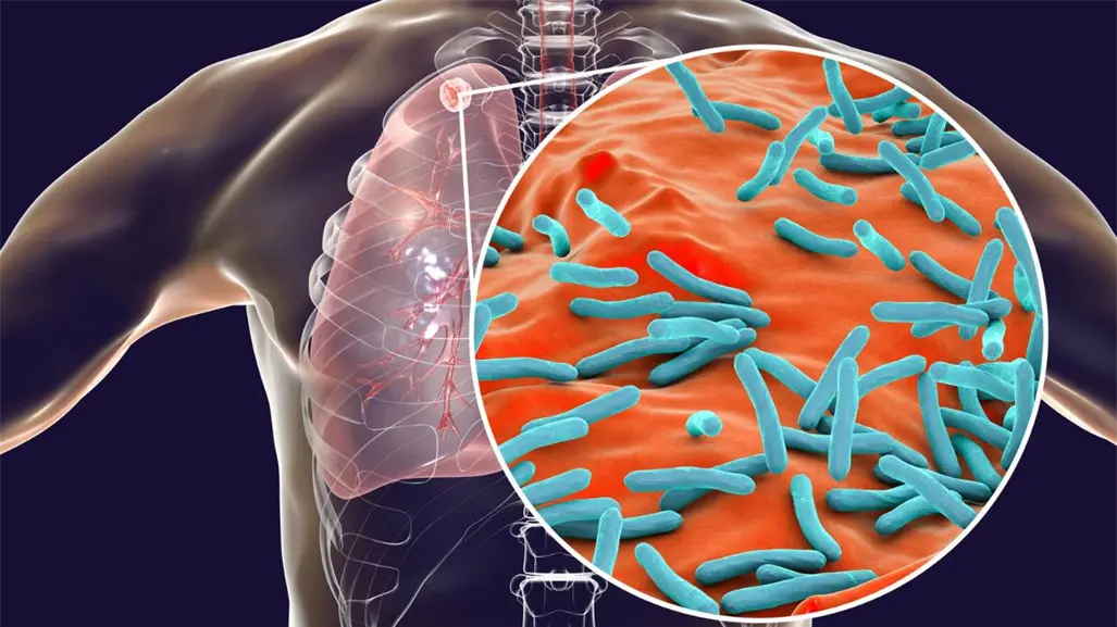 Tuberculosis en Edomex preocupa por falta de vacuna BCG y especialistas piden medidas preventivas