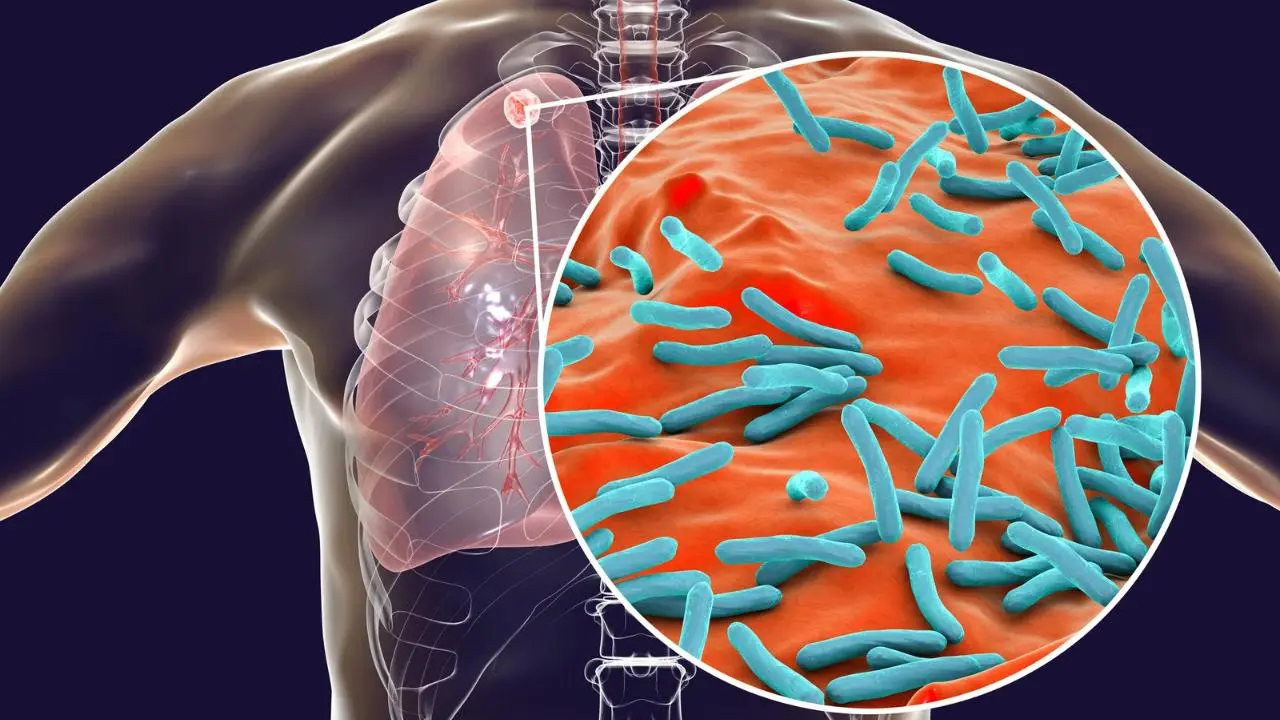 Tuberculosis en Edomex preocupa por falta de vacuna BCG y especialistas piden medidas preventivas. Foto: Canva